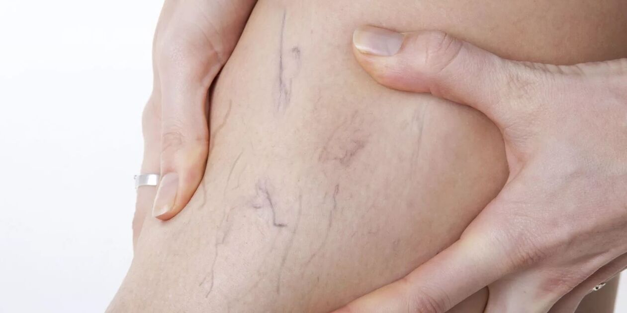 Para përdorimit të kremit me varicone